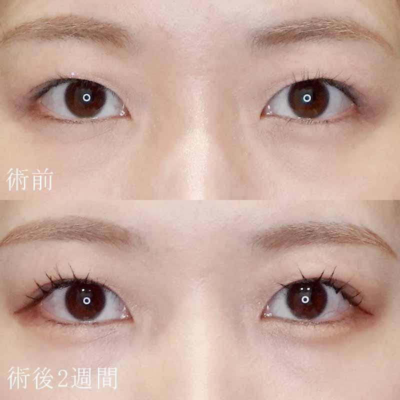 杉山医師の二重埋没法症例写真