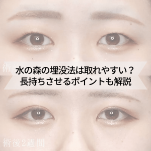 水の森の二重埋没法は取れやすい?長持ちさせるポイントも解説