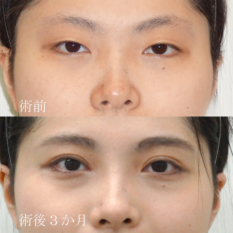 二重切開法＋目頭切開（W法）の症例写真