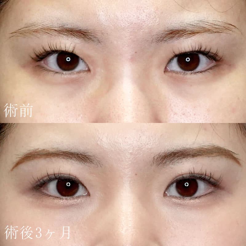 二重切開法の症例写真
