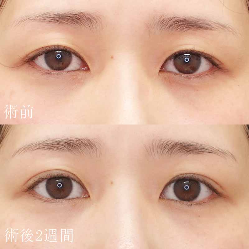 二重埋没法症例写真