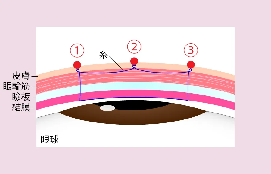 他院で行われている二重埋没法の糸の掛け方の例3