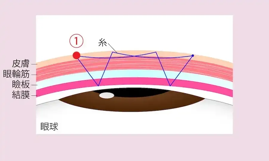 他院で行われている二重埋没法の糸の掛け方の例4