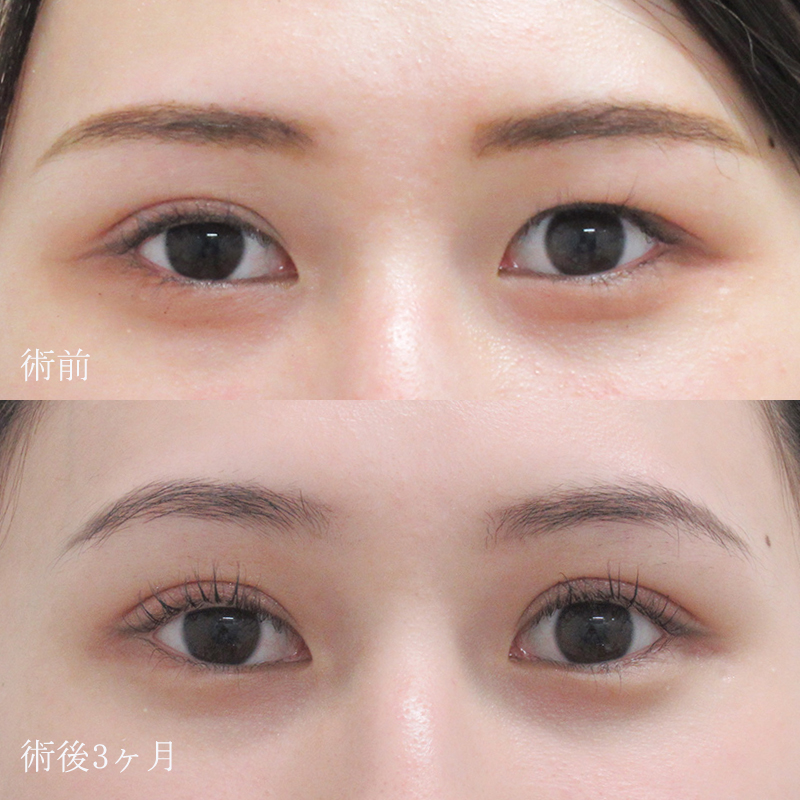 竹村医師の二重切開法の症例写真