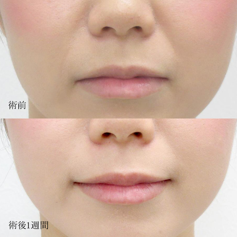 口角ボトックスで失敗することはある?原因と注意点を解説!|水の森美容クリニック【公式】