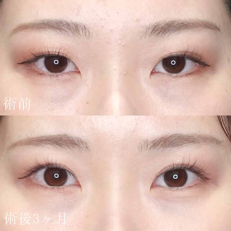 二重切開法の症例写真①