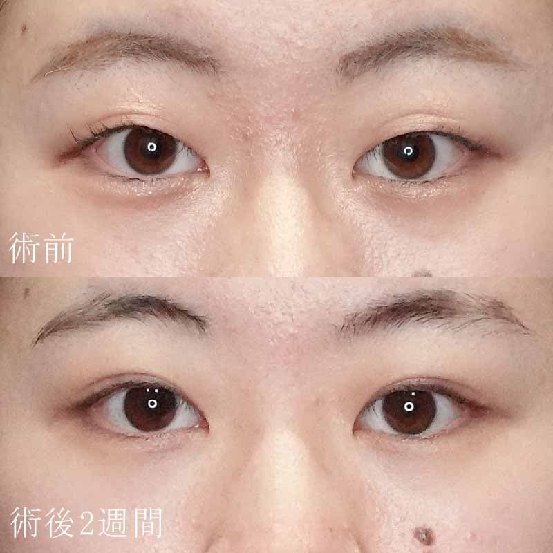 二重埋没法症例写真