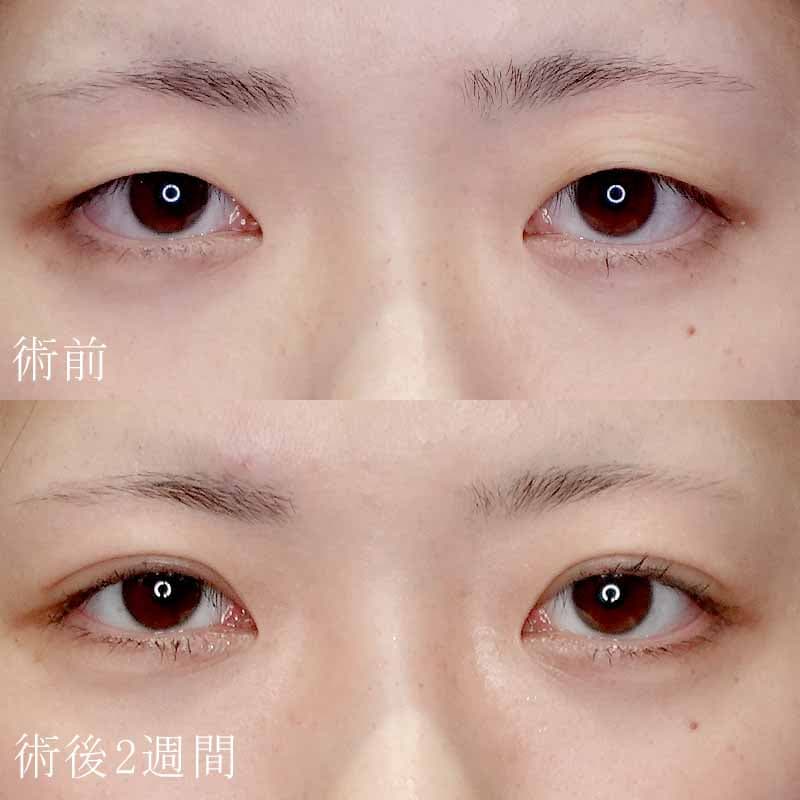 常盤医師の二重埋没法症例写真