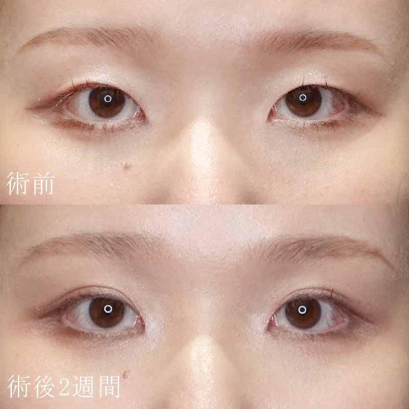 永濱医師の二重埋没法の症例写真