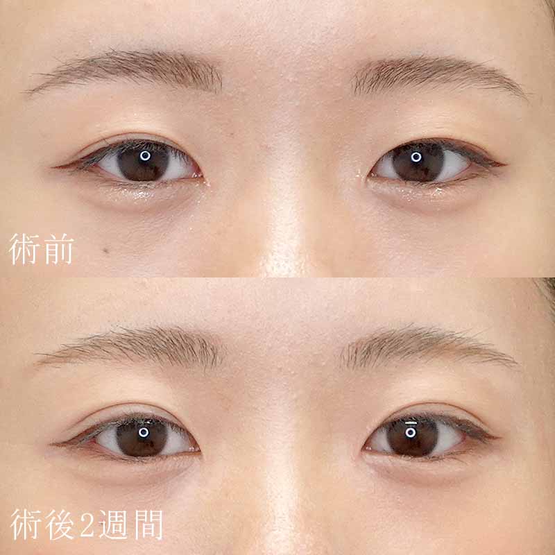 眞鳥医師の二重埋没法の症例写真