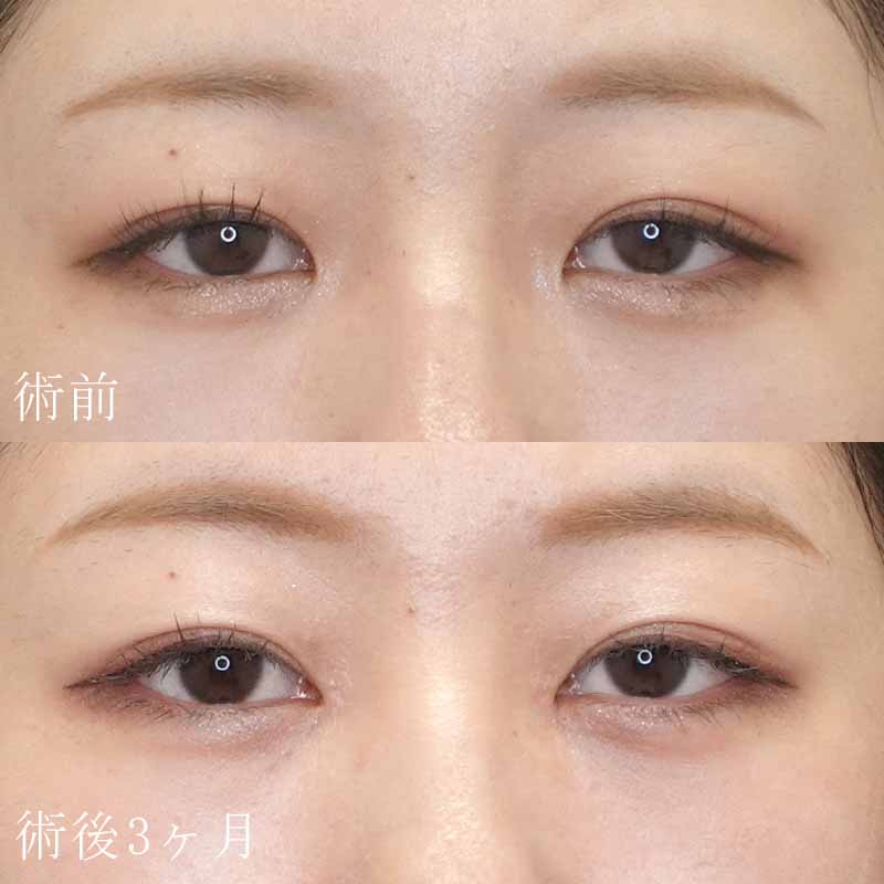 目頭切開（Z法）の症例写真