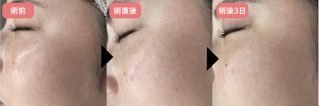 ピコトーニングの経過