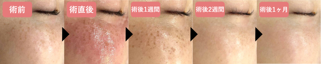 ピコスポットの経過