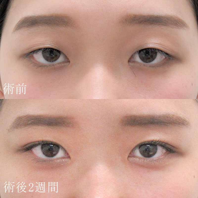 古村医師の二重埋没法の症例写真②