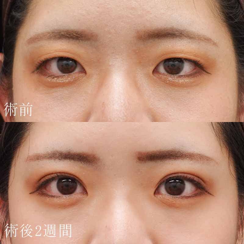 古村医師の二重埋没法の症例写真①