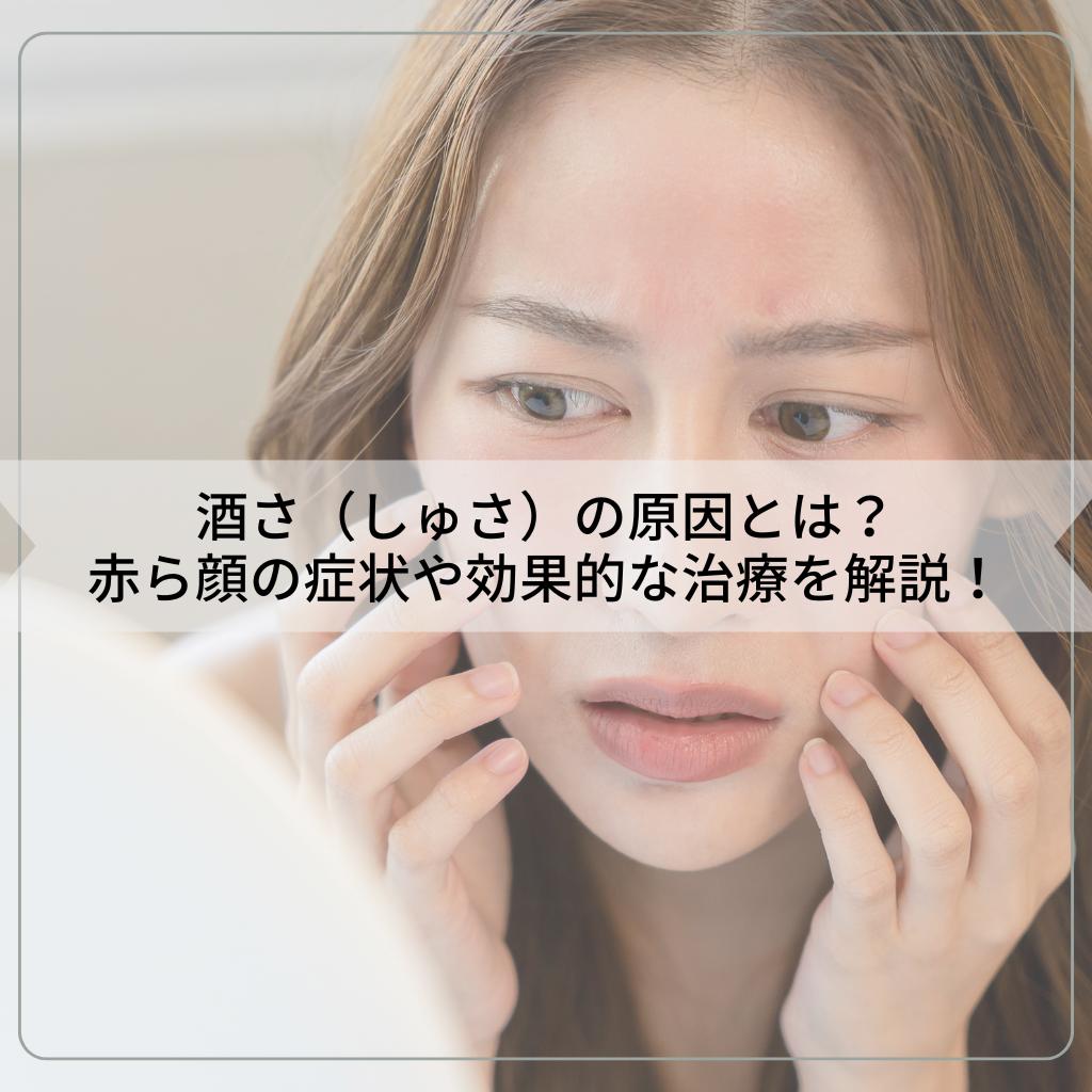 酒さ（しゅさ）の原因とは？赤ら顔の症状や効果的な治療を解説！