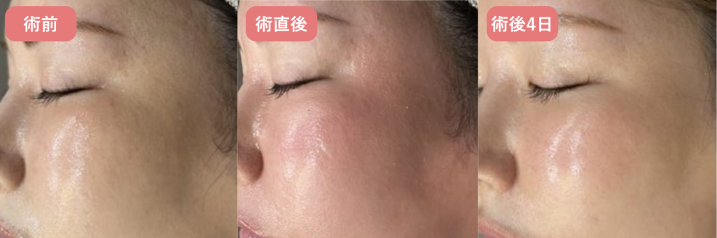 ピコフラクショナルの経過