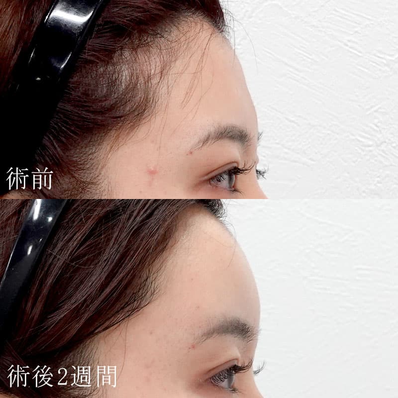 額のヒアルロン酸注射症例写真