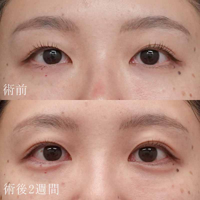 二重埋没法＋涙袋のヒアルロン酸注入症例写真