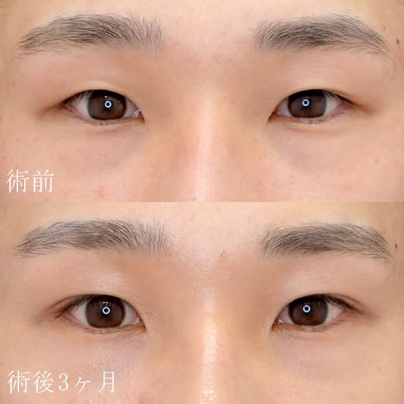 長田医師執刀 二重切開法