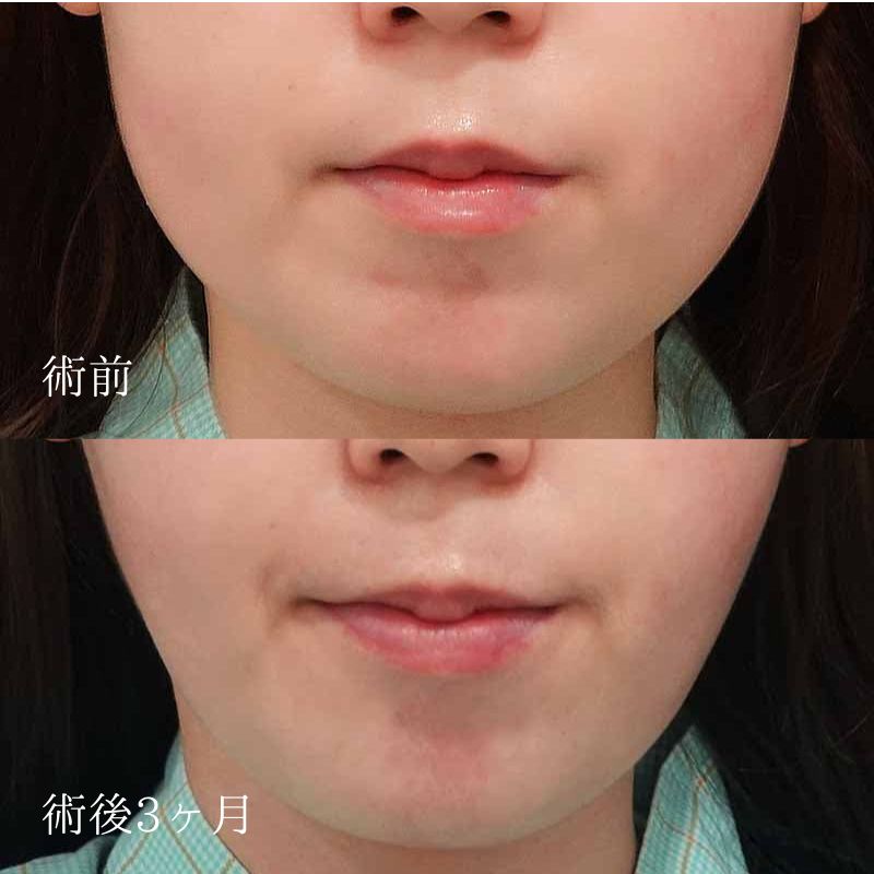 顔の脂肪吸引の症例写真1