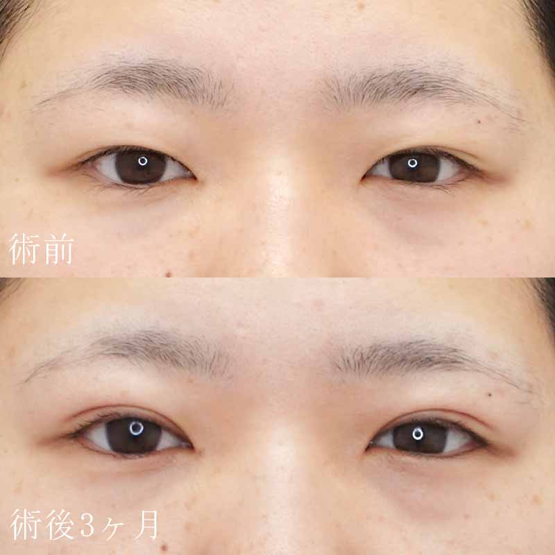 長田医師執刀 二重切開法