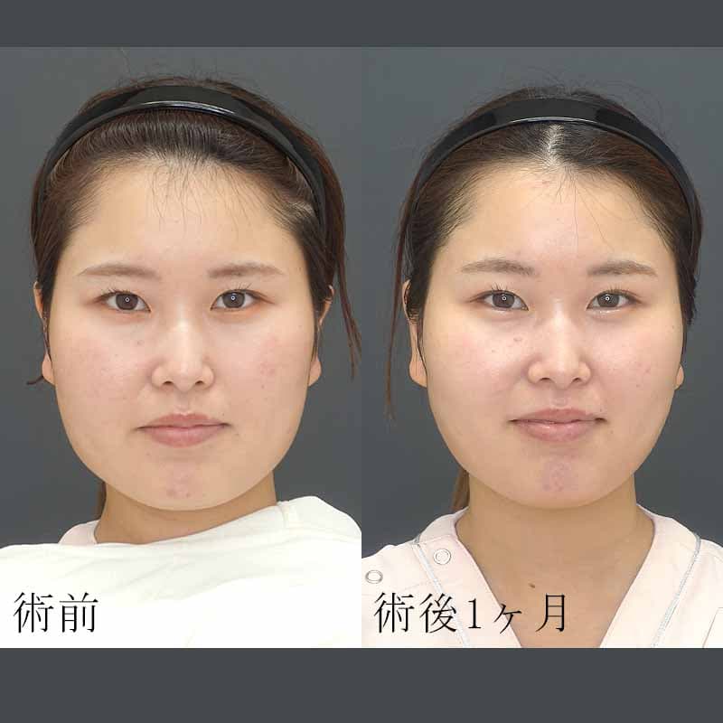 エラのボトックス注射の症例写真3
