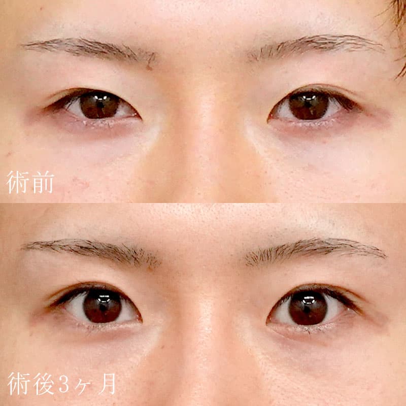 二重切開法症例写真②