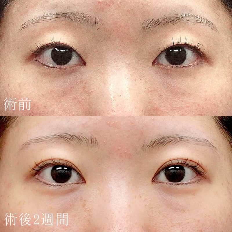二重埋没法＋涙袋のヒアルロン酸注入セットの症例写真