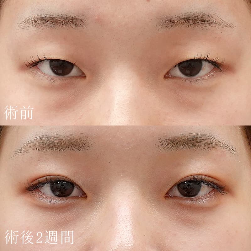 二重埋没法＋涙袋のヒアルロン酸注入セットの症例写真