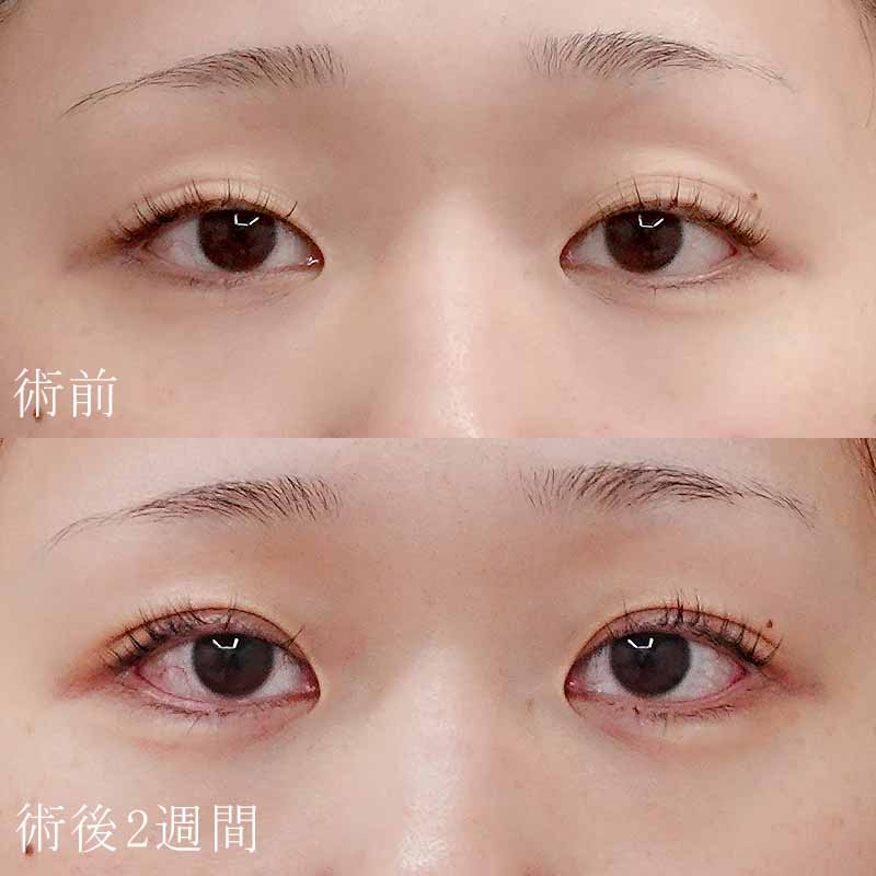 二重埋没法＋涙袋のヒアルロン酸注入セットの症例写真①