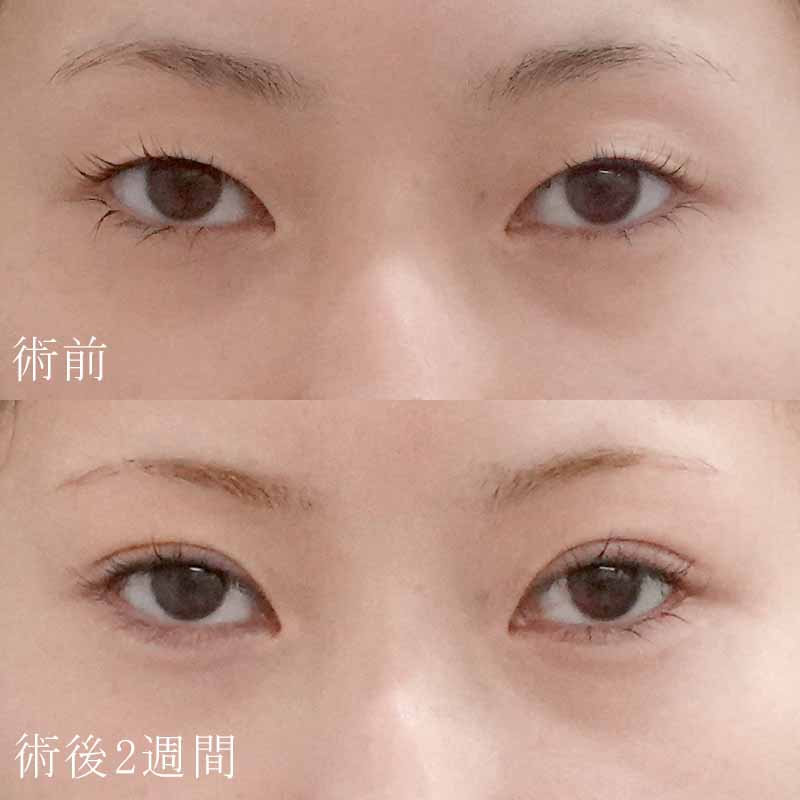 二重埋没法＋涙袋のヒアルロン酸注入セットの症例写真②