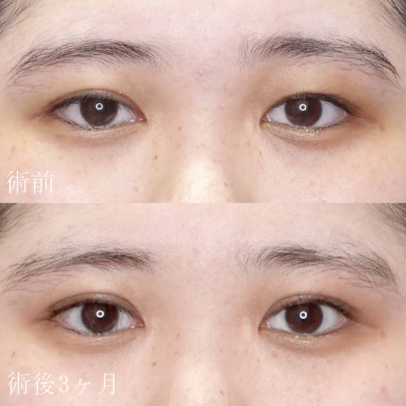塚原院長の二重切開法症例写真1