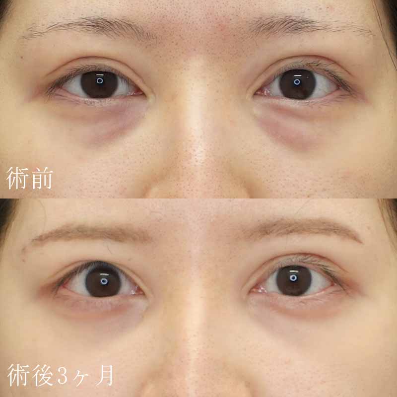 西川医師裏ハムラ法症例写真