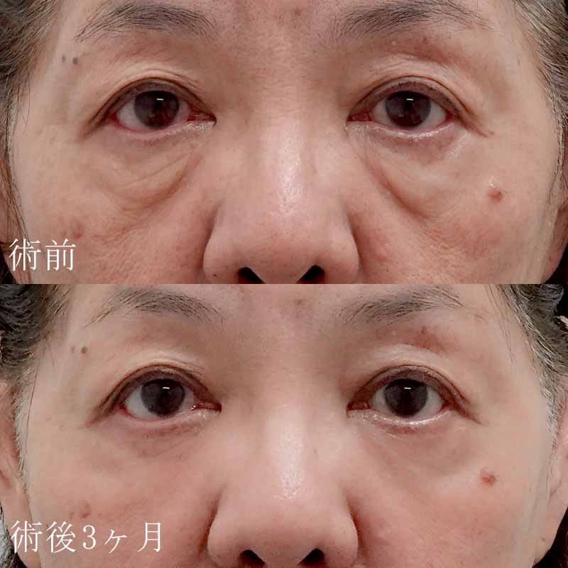 塚原医師ハムラ法症例写真