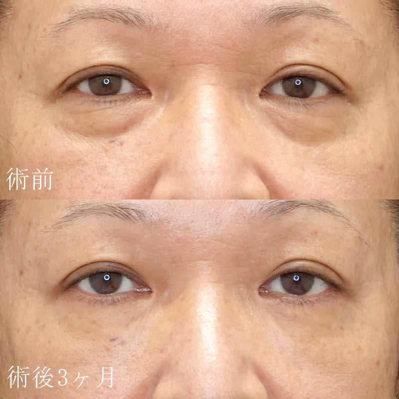 古村医師ハムラ法症例写真