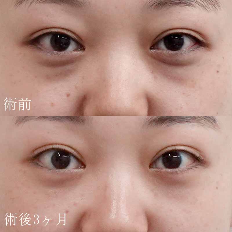 東京渋谷院古村院長の裏ハムラ法症例写真