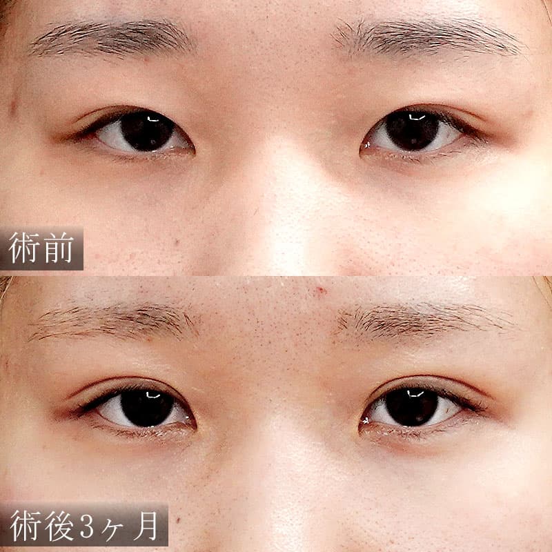 古村医師の二重切開法症例写真1