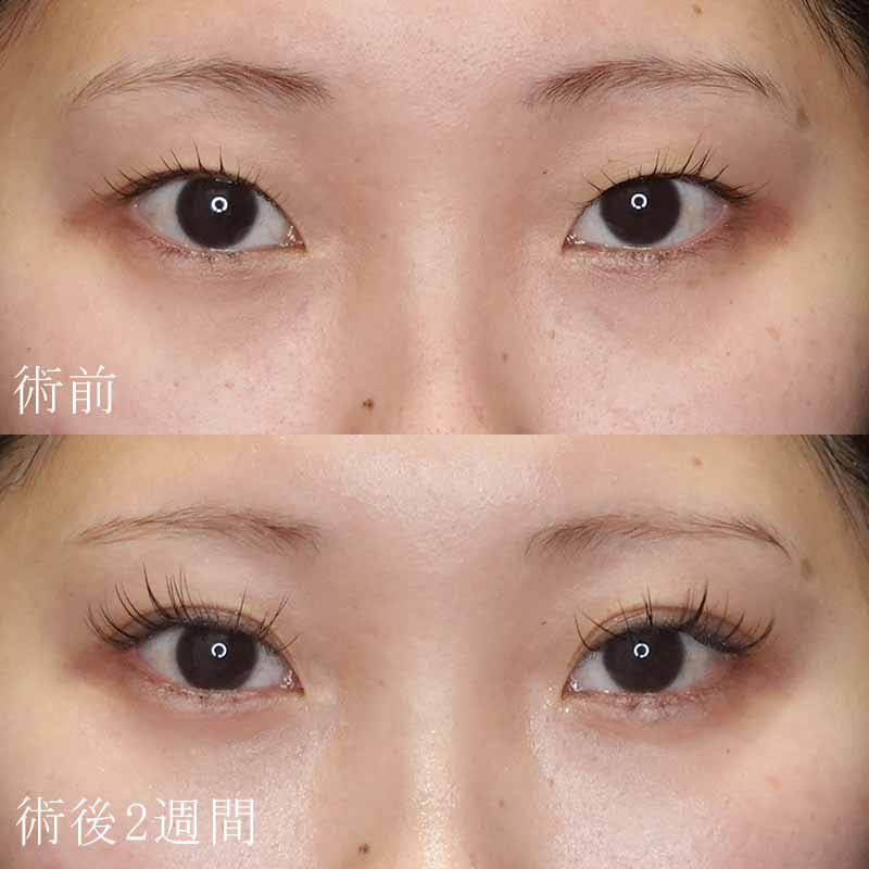 二重埋没法+涙袋のヒアルロン酸注入症例写真