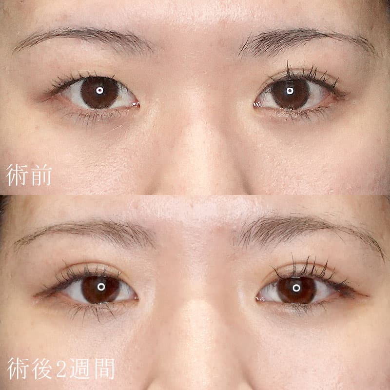 二重埋没法の症例写真②