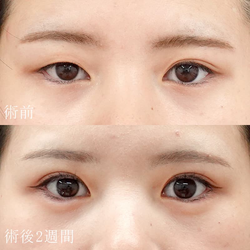 二重埋没法と涙袋のヒアルロン酸の症例写真②