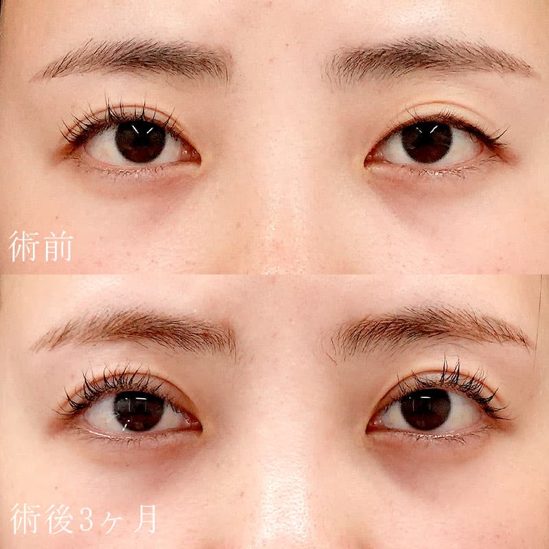 二重切開法の症例写真①