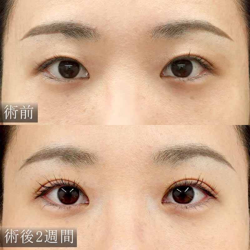 二重埋没法と涙袋のヒアルロン酸の症例写真①