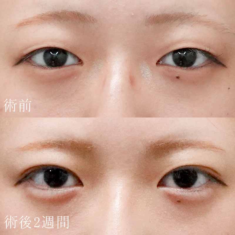 常盤医師の二重埋没法＋涙袋のヒアルロン酸注入症例写真