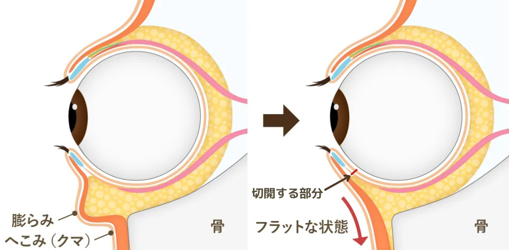 裏ハムラ法イメージイラスト