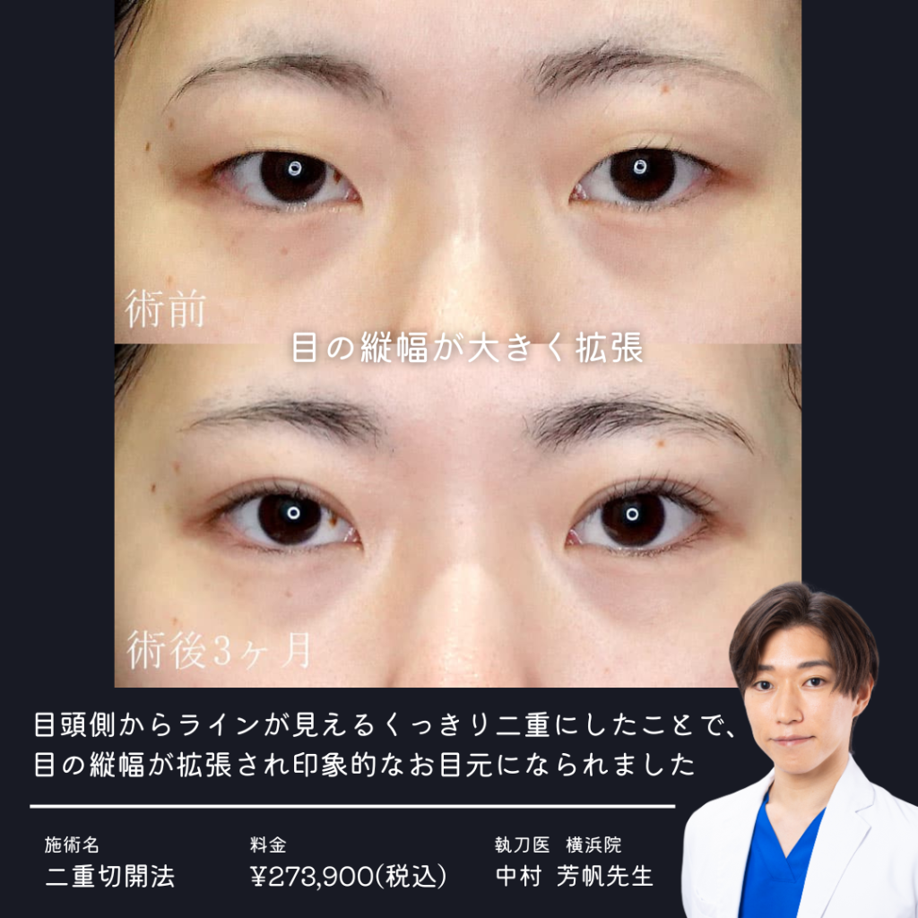 二重切開法の症例写真①