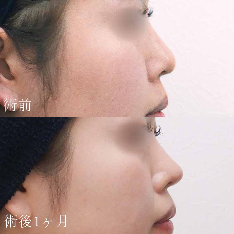 西川医師鼻尖縮小＋耳介軟骨移植症例写真
