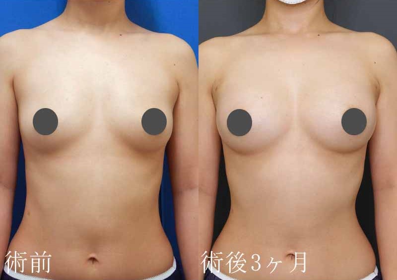 脂肪注入豊胸症例写真