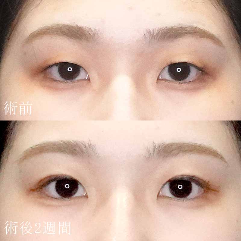 新宿院 小糸医師二重埋没法症例写真