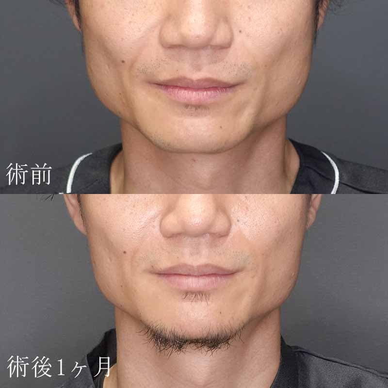 新宿院　小糸医師のエラのボトックス注射の症例写真